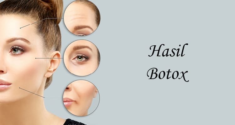 Botox Treatment : Arti, Manfaat, dan Prosesnya