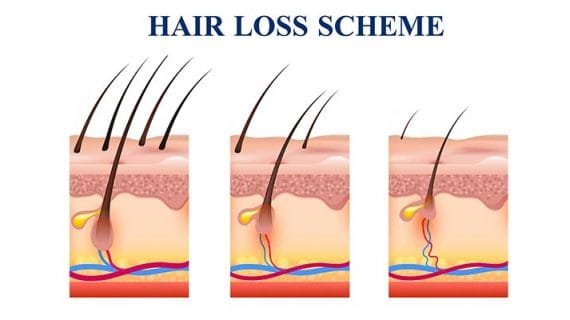 Mengenal Perawatan Rambut PRP Treatment