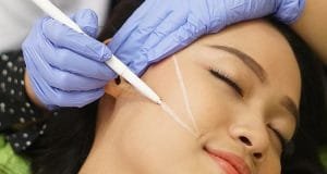 Metode Thread Lift