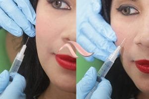 Ini Dia Perawatan Pasca Thread Lift