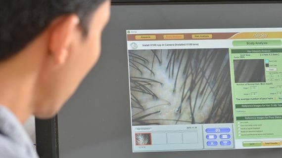 Yuk Ketahui Alasan Perlu PRP Treatment Yang Tepat!