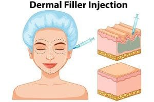 Manfaat dermal filler untuk wajah
