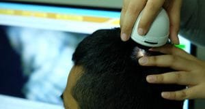 Mengenal Perawatan Rambut PRP Treatment