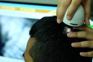 Kesalahan Perawatan dengan Mengenal Perawatan Rambut PRP Treatment