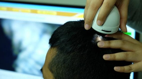 Kesalahan Perawatan dengan Mengenal Perawatan Rambut PRP Treatment