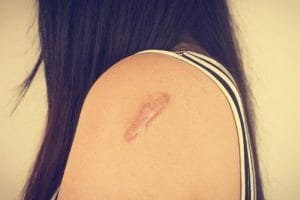 Pengertian Keloid, Penyebab dan Cara Mengatasinya