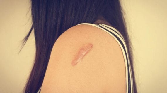 Pengertian Keloid, Penyebab dan Cara Mengatasinya