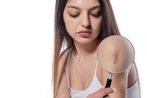Ini Penyebab dan Kiat Atasi Keloid
