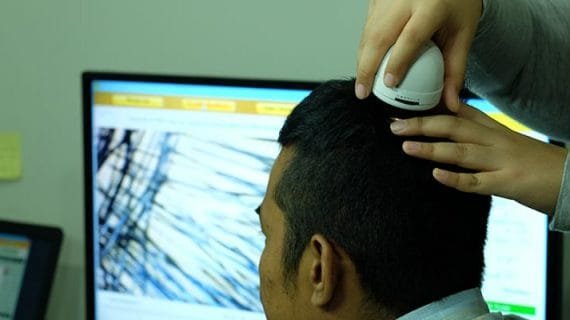 Ketahui Efek Samping Transplantasi Rambut Sebelum Naik ke Meja Operasi