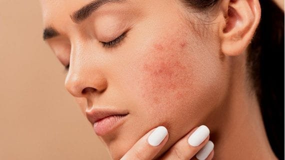 Penyebab Skin Barrier Rusak dan Cara Mengatasinya Terampuh