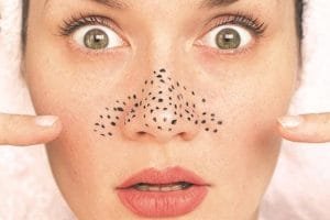 Cara Hilangkan Komedo dengan Mudah!