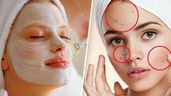 Flek diwajah Mengganggu? Atasi dengan Hal Ini!