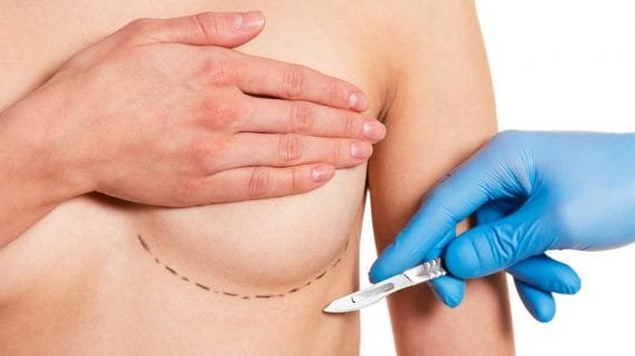 Prosedur Operasi Plastik Payudara yang Harus Anda Ketahui