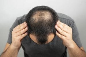 Hair Loss Awareness Pada Bulan Agustus
