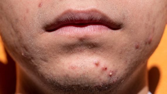 Pahami 5 Cara Mencegah Jerawat Timbul Lagi di Wajah