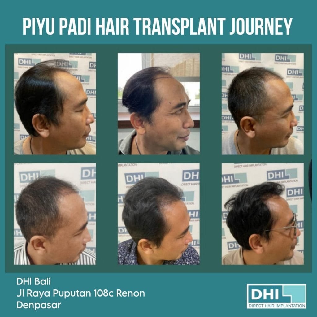 Piyu Hair Transplant