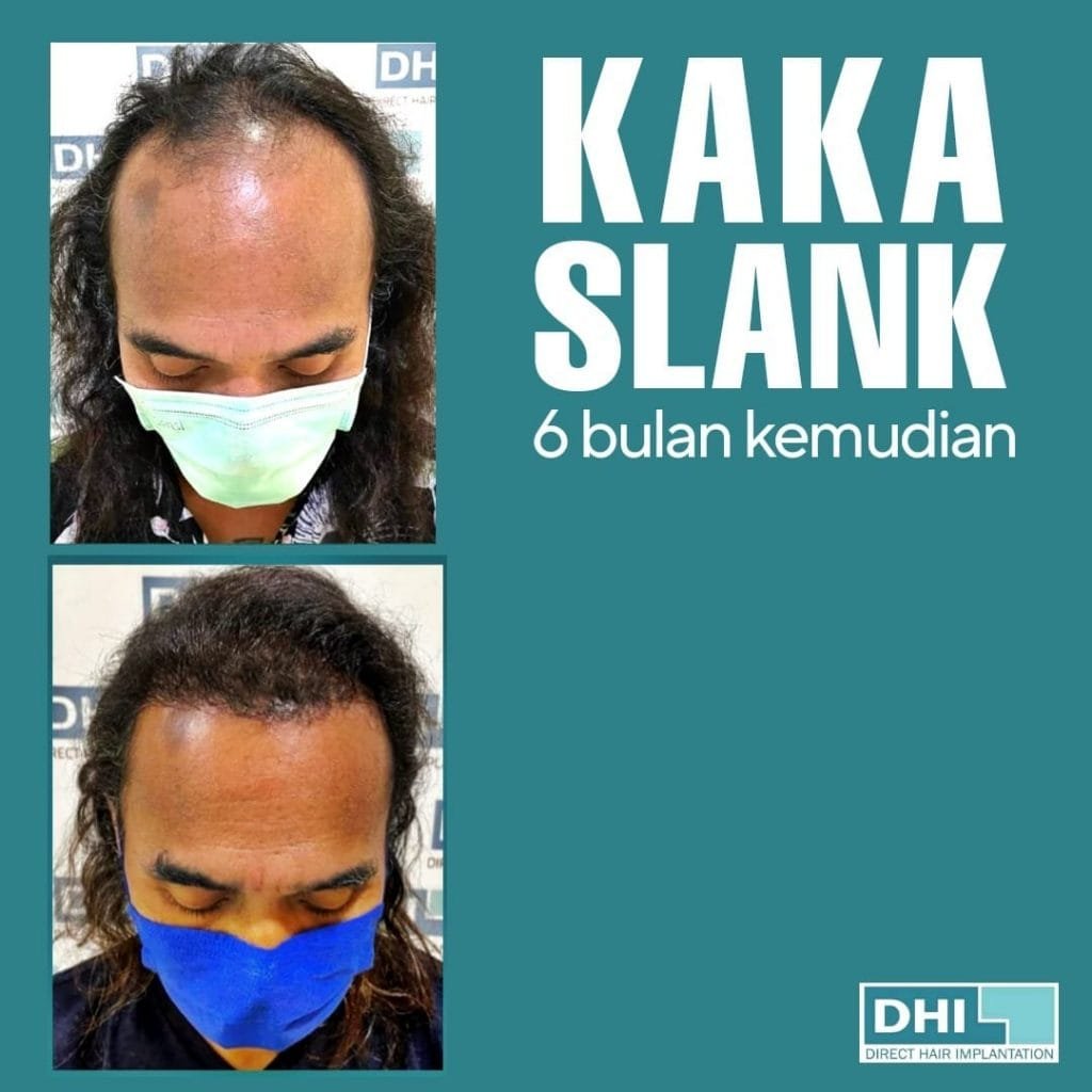 Kaka Hair Trsnaplant