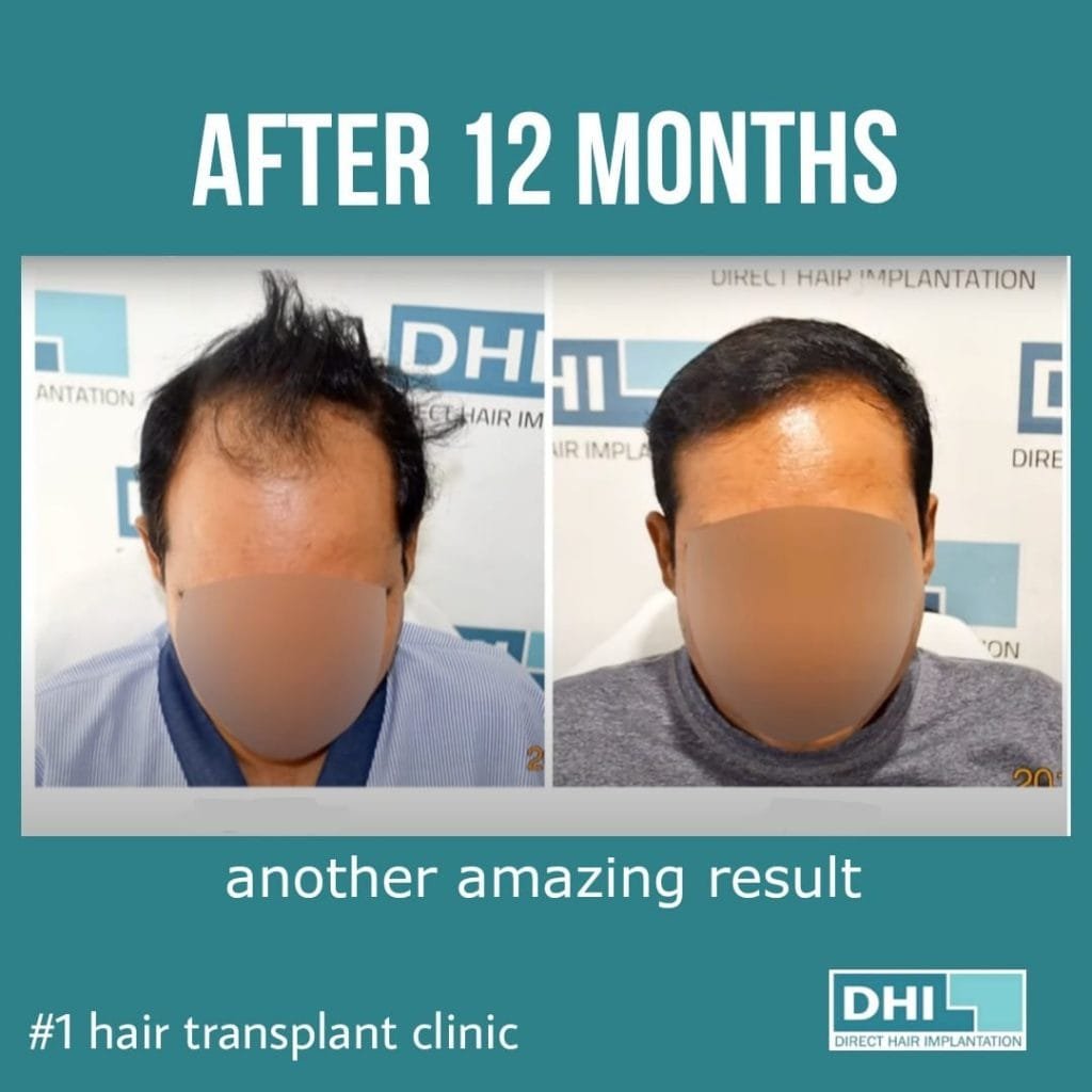 Hair Transplant DHI