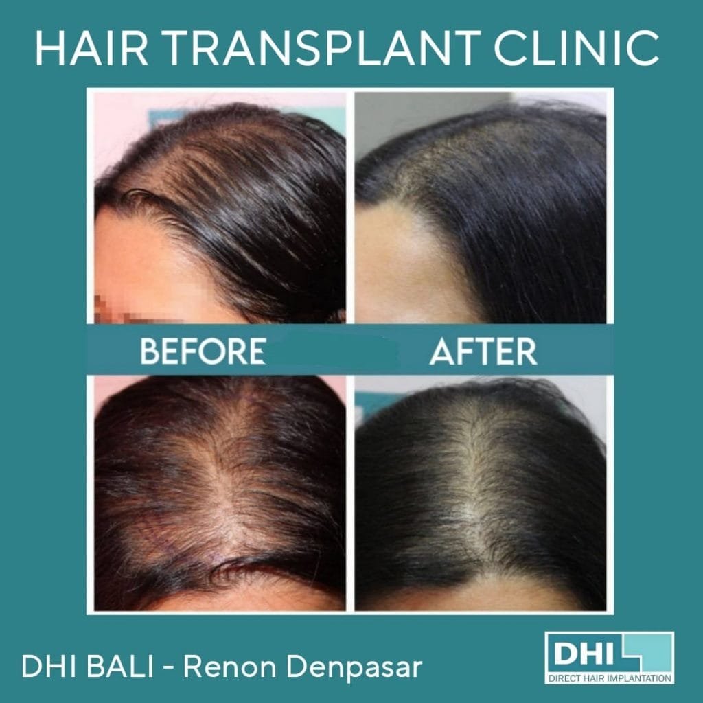 Hair Transplant Bali