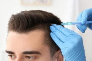 Transplantasi Rambut FUE dan Prosedur yang Harus Dilakukan