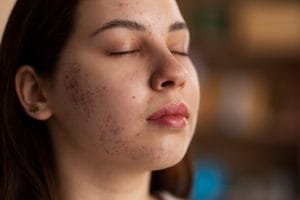 Kenali Terapi Platelet-Rich Plasma untuk Bekas Jerawat