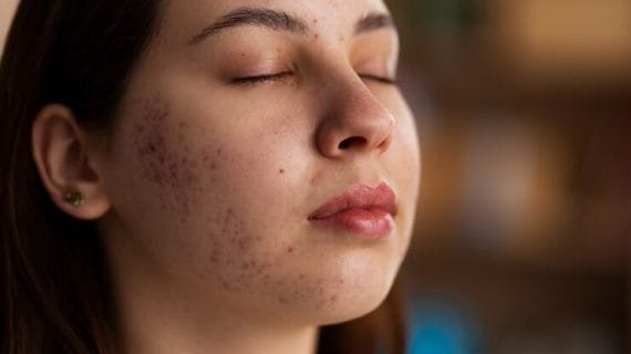Kenali Terapi Platelet-Rich Plasma untuk Bekas Jerawat