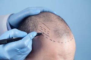 Faktor Transplantasi Rambut Berhasil Penting Diketahui