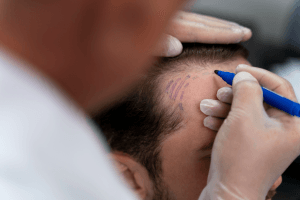 Apakah Tanam Rambut Sakit? Simak Penjelasannya