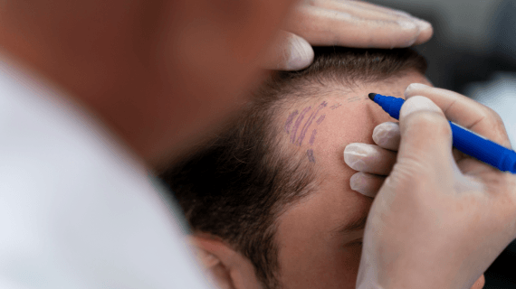 Apakah Tanam Rambut Sakit? Simak Penjelasannya