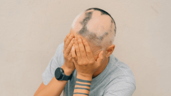 5 Penyebab Rambut Pitak (Alopecia Areata) Plus Solusi Ampuh dari dr Farmanina