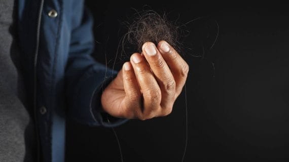 7 Penyebab Rambut Rontok Parah Pria + Solusi Medis dari dr Farmanina
