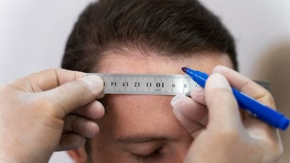 Risiko Tanam Rambut dan Apa yang Perlu Anda Ketahui Sebelum Memutuskan