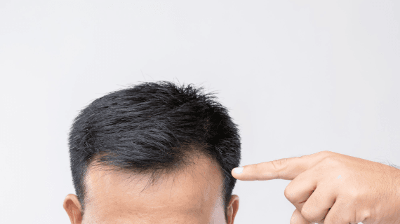 Transplantasi Rambut Bertahan Berapa Lama? Cari Tahu di Sini!