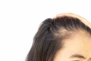 Ini Penyebab Rambut Tipis dan Solusi Terbaiknya!