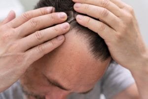 7 Ciri Akar Rambut Mati & Cara Atasi Sebelum Botak