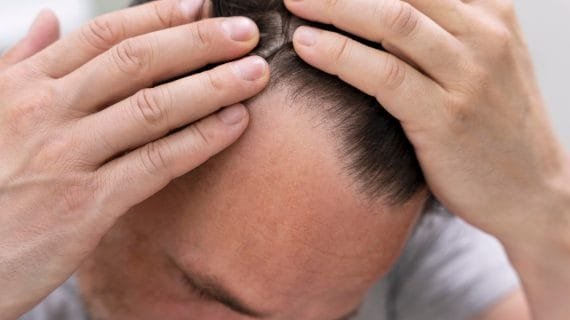 7 Ciri Akar Rambut Mati & Cara Atasi Sebelum Botak