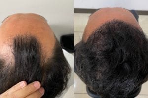 Hasil Tanam Rambut DHI: Before-After 3-12 Bulan