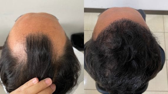 Hasil Tanam Rambut DHI: Before-After 3-12 Bulan