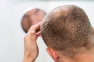 Apa Penyebab Rambut Pitak dan Dapatkah Tumbuh Lagi?