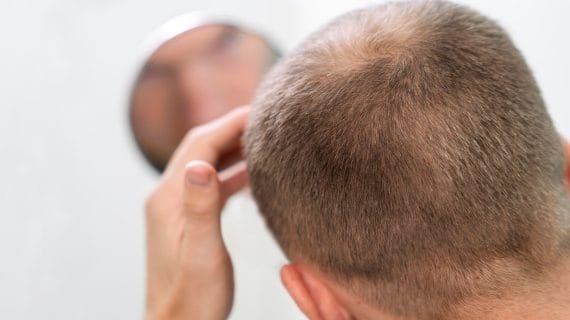 Apa Penyebab Rambut Pitak dan Dapatkah Tumbuh Lagi?