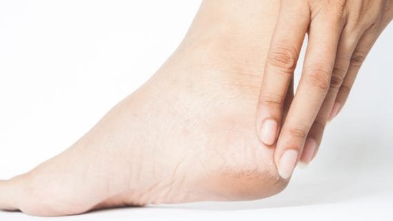 Pentingnya Perawatan Tumit Kaki dalam Rutinitas Kecantikan Anda