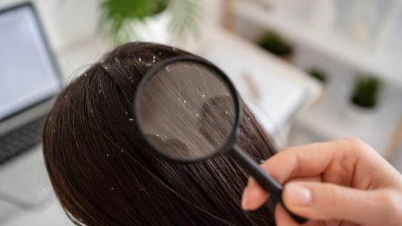 Perbedaan Ketombe dan Dermatitis Seboroik, Kenali Gejalanya untuk Perawatan yang Tepat