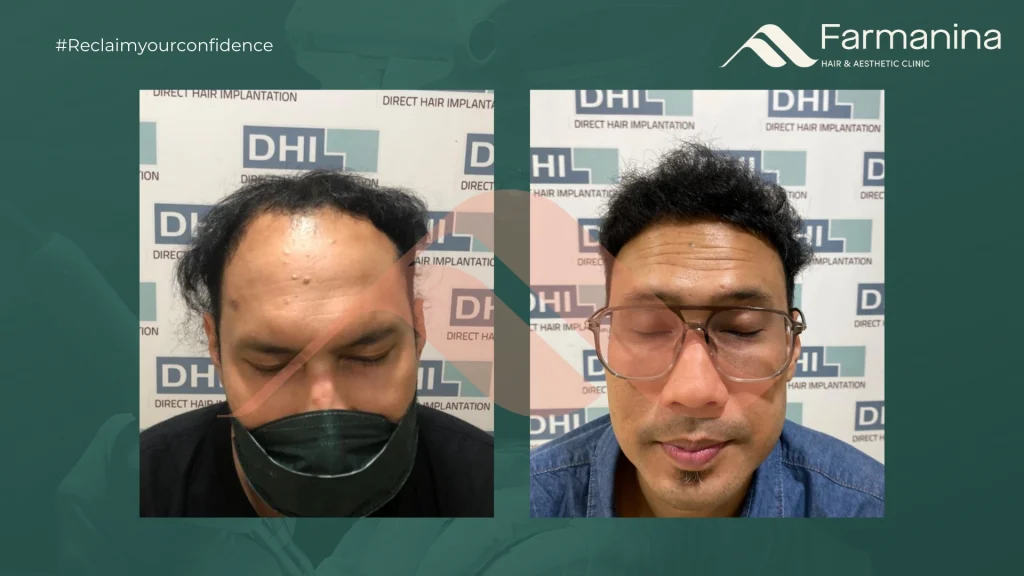 Gallery Hasil Hair Transplant