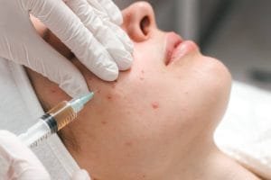 Apa Itu Acne Injection dan Cara Kerjanya untuk Atasi Jerawat