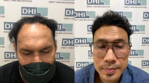 Before After Hair Transplant: Perubahan yang Dapat Diharapkan