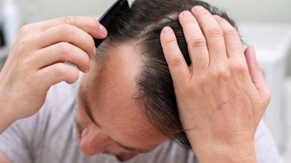 Punya Masalah Garis Rambut Mundur? Ini Solusi Pemulihannya