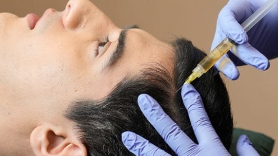 PRP Treatment: Solusi Perawatan untuk Kulit Kepala dan Rambut Sehat
