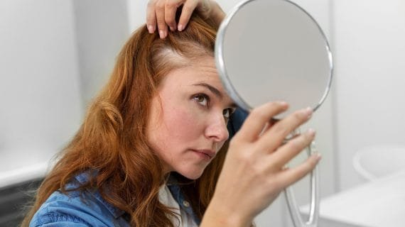 Perawatan Garis Rambut Mundur untuk Wanita dengan Aman