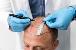 Manfaat Transplantasi Rambut, Alis, Jenggot, Janggut, dan Brewok: Solusi untuk Penampilan Lebih Percaya Diri