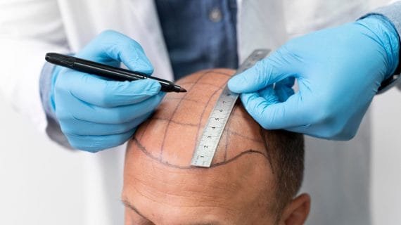 Manfaat Transplantasi Rambut, Alis, Jenggot, Janggut, dan Brewok: Solusi untuk Penampilan Lebih Percaya Diri